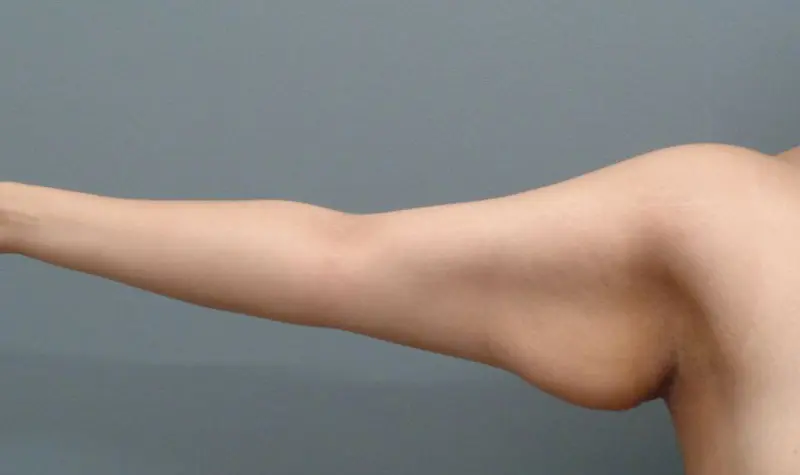 Arm Lift Before & After Pictures
