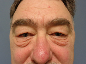 Blepharoplasty Before and After Pictures Nashville, TN