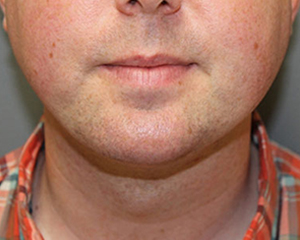 Chin Augmentation Before and After Pictures Nashville, TN