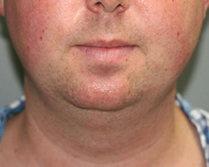 Chin Augmentation Before and After Pictures Nashville, TN