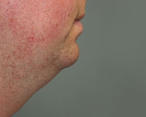 Chin Augmentation Before and After Pictures Nashville, TN