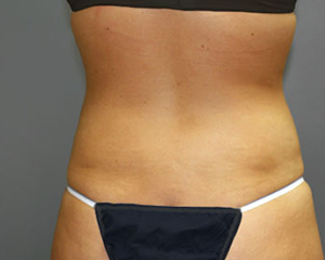 Liposuction Before and After Pictures Nashville, TN
