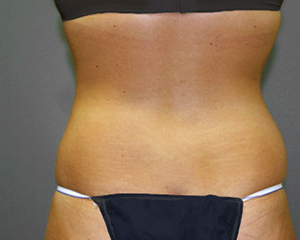 Liposuction Before and After Pictures Nashville, TN