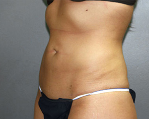 Liposuction Before and After Pictures Nashville, TN