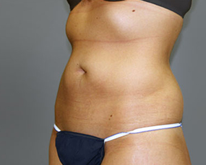 Liposuction Before and After Pictures Nashville, TN