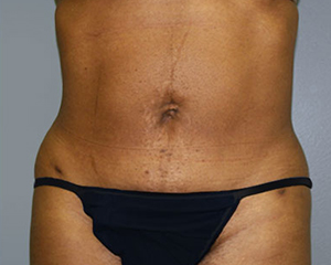 Liposuction Before and After Pictures Nashville, TN