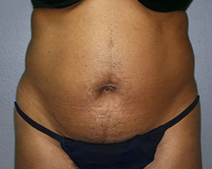 Liposuction Before and After Pictures Nashville, TN