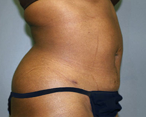 Liposuction Before and After Pictures Nashville, TN