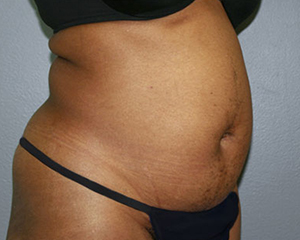 Liposuction Before and After Pictures Nashville, TN