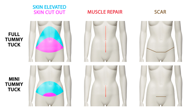Liposuction vs. Tummy Tuck: What's the Difference?