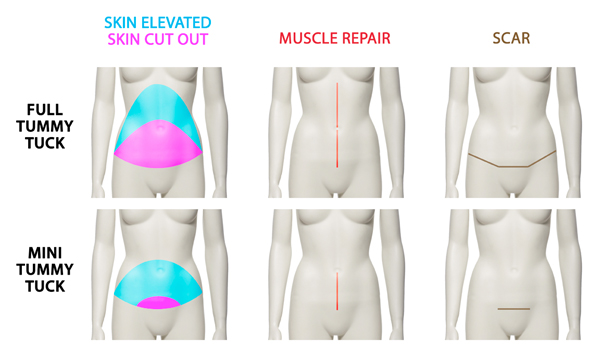 Mini Tummy Tuck Boston - Mini Abdominoplasty Brookline, MA