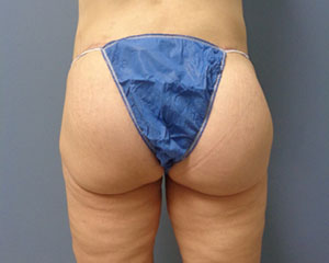 Butt Augmentation Before and After Pictures Nashville, TN