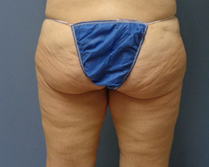 Butt Augmentation Before and After Pictures Nashville, TN