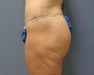 Butt Augmentation Before and After Pictures Nashville, TN