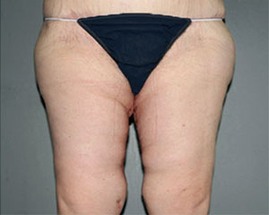 Thigh Lift Before and After Pictures Nashville, TN