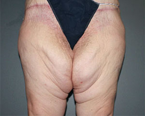 Thigh Lift Before and After Pictures Nashville, TN