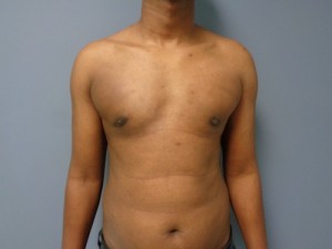 Gynecomastia Before and After Pictures Nashville, TN