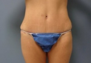 Tummy Tuck Before and After Pictures Nashville, TN