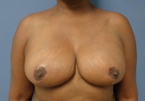 Breast Reduction Before and After Pictures Nashville, TN