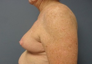 Breast Reduction Before and After Pictures Nashville, TN