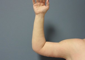 Arm Lift Before and After Pictures Nashville, TN