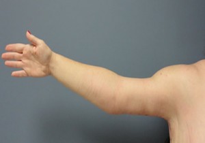 Arm Lift Before and After Pictures Nashville, TN