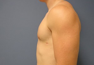 Gynecomastia Before and After Pictures Nashville, TN