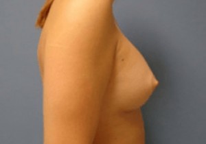 Breast Augmentation Before and After Pictures Nashville, TN