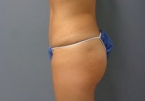 Tummy Tuck Before and After Pictures Nashville, TN