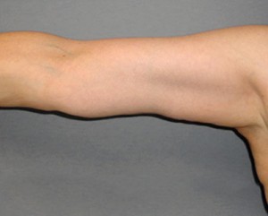 Arm Lift Before and After Pictures Nashville, TN