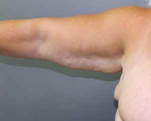 Arm Lift Before and After Pictures Nashville, TN