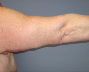 Arm Lift Before and After Pictures Nashville, TN