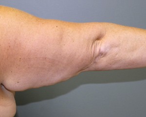 Arm Lift Before and After Pictures Nashville, TN