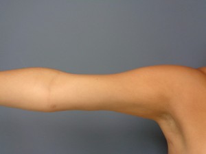 Arm Lift Before and After Pictures Nashville, TN