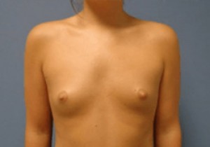 Breast Augmentation Before and After Pictures Nashville, TN