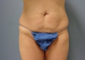 Tummy Tuck Before and After Pictures Nashville, TN