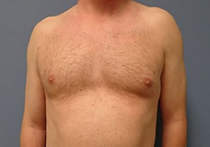 Gynecomastia Before and After Pictures Nashville, TN