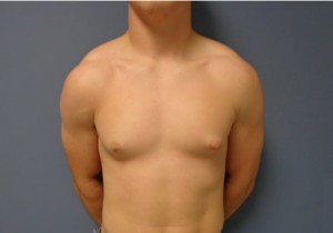 Gynecomastia Before and After Pictures Nashville, TN