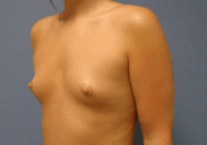 Breast Augmentation Before and After Pictures Nashville, TN