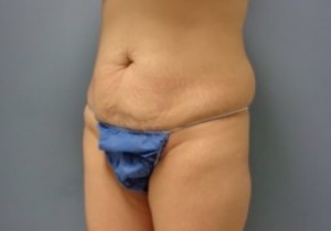 Tummy Tuck Before and After Pictures Nashville, TN