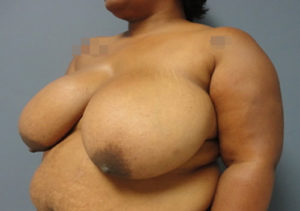 Breast Reduction Before & After Pictures in Nashville, TN