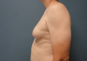 Gynecomastia Before and After Pictures Nashville, TN