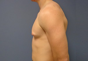 Gynecomastia Before and After Pictures Nashville, TN