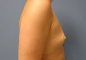 Breast Augmentation Before and After Pictures Nashville, TN