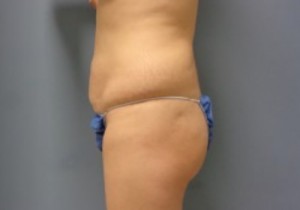 Tummy Tuck Before and After Pictures Nashville, TN