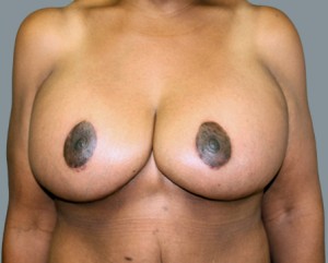 Breast Augmentation with Lift Before and After Pictures Nashville, TN