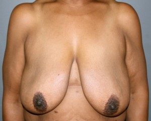 Breast Augmentation with Lift Before and After Pictures Nashville, TN