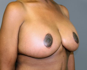 Breast Augmentation with Lift Before and After Pictures Nashville, TN