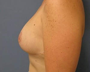 Breast Reduction Before and After Pictures Nashville, TN