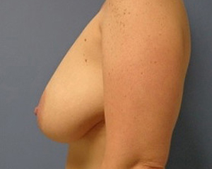 Breast Reduction Before and After Pictures Nashville, TN